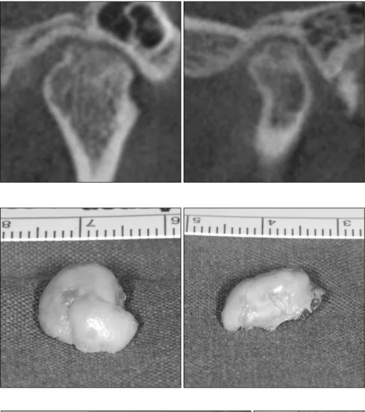 Fig. 4. Complete removal of the  mass, specimen shows the fusion of  disc and condylar head.