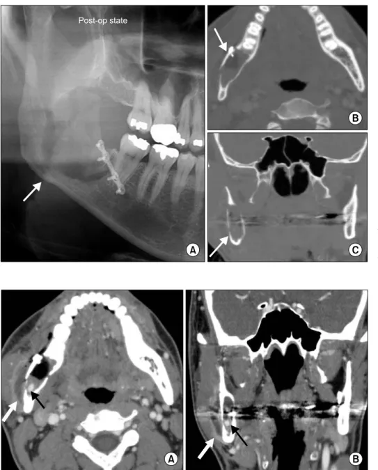 Fig. 2. One week postoperative  (post-op) radiographic examination  revealed a radiolucent cavity (A∼C: