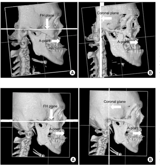 Fig. 1. Reference plane and point  using before Le Fort I osteotomy  and bilateral sagittal split ramus  osteotomy in this study