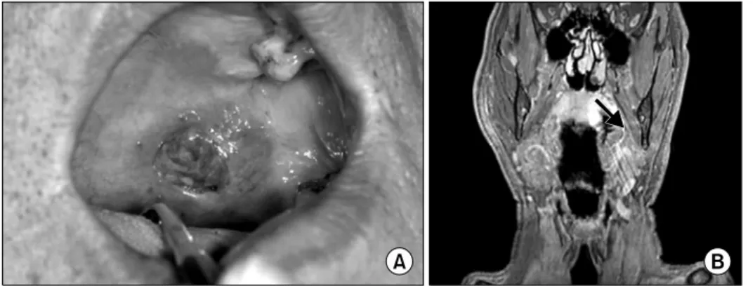 Fig. 2. Surgical specimen. About 3 cm size.