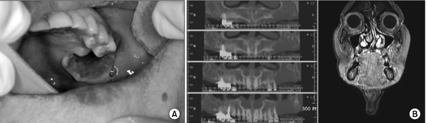 Fig. 6. (A) Residual defect after  partial maxillectomy. Buccal fat pad in the defect site