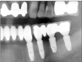 Fig. 6. Radiograph after second surgery (4.5 months after im- im-plantation). Bone resorption was observed between #35 and #36
