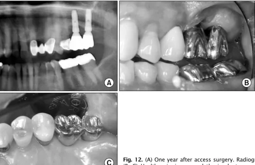 Fig. 12. (A) One year after access surgery. Radiograph demonstrating no bone change. 