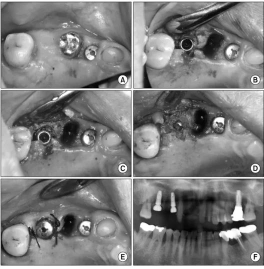 Fig. 17. One month after regenerative surgery. Progression of bone  re-sorption was observed.
