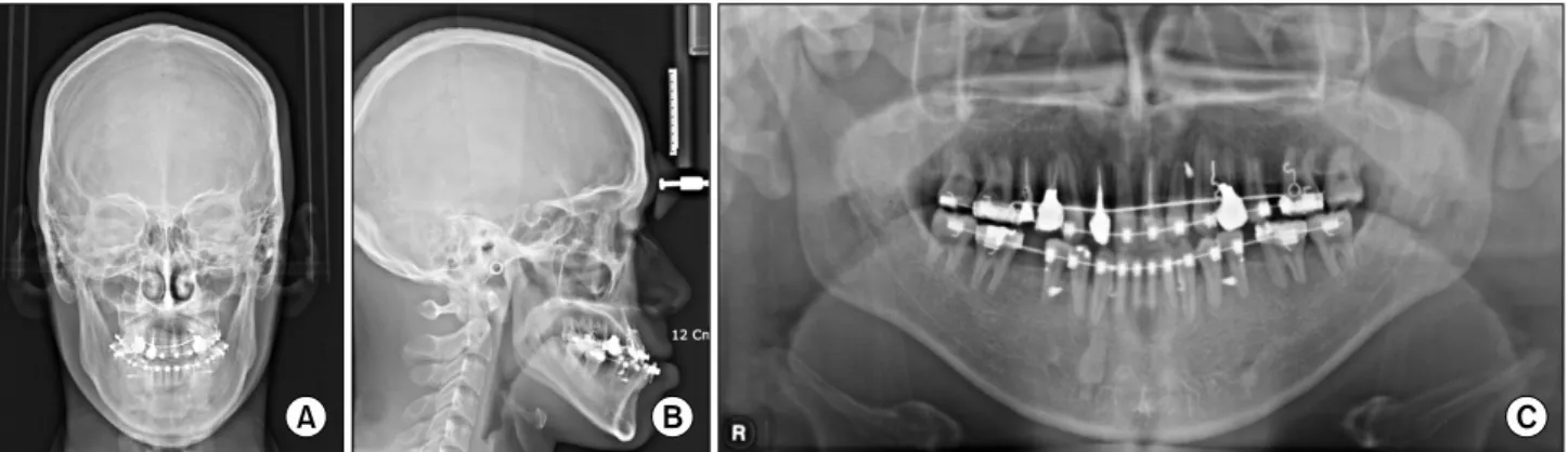 Fig. 1. Preoperative radiographs. (A) Postero-anterior view. (B) Lateral view. (C) Panoramic view.