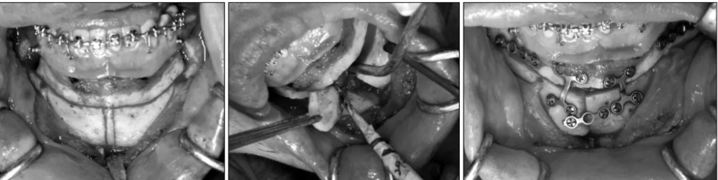 Fig. 5. Symphyseal ostectomy. Symphyseal ostectomy was performed by vertical osteotomy below horizontal osteotomy line of anterior segmental osteotomy in shymphysis