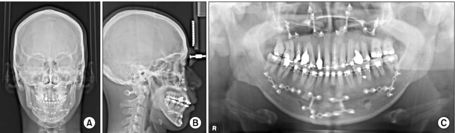 Fig. 6. Postoperative radiographs (9 months). (A) Postero-anterior view. (B) Lateral view