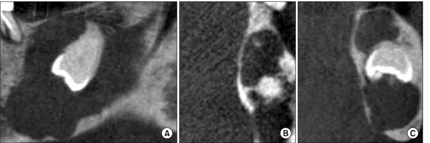 Fig. 1. Preoperative panoramic view. Ill-defined radiolucent lesion (about 25×25 mm), including #38 impacted tooth on the left lower posterior mandible.