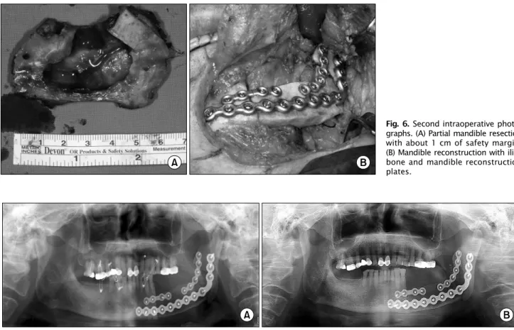 Fig. 7. Postoperative panoramic views. (A) Postoperative 1 month, (B) postoperative 10 months.