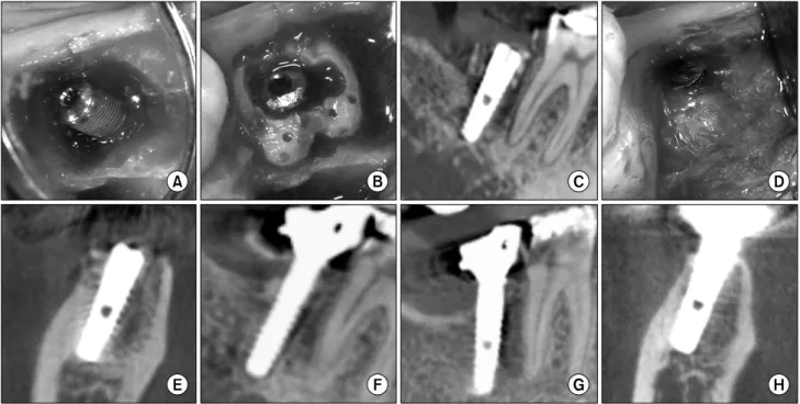 Fig. 1. (A) Implant was installed immediately after extraction at the right mandibular 2 nd  molar area
