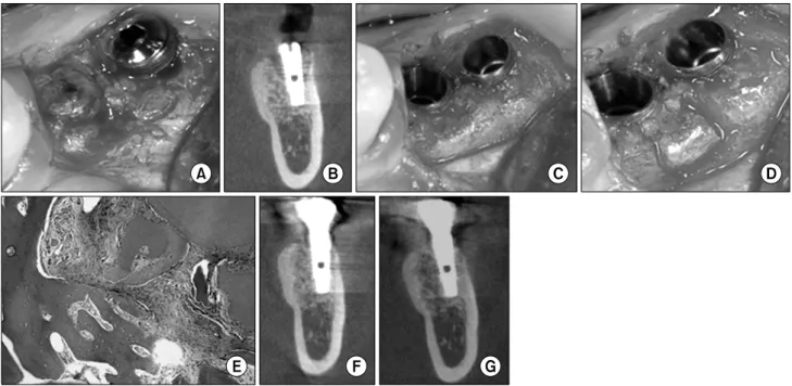 Fig. 2. (A) Implant was installed with AutoBT block at left mandibular 1 st  molar area