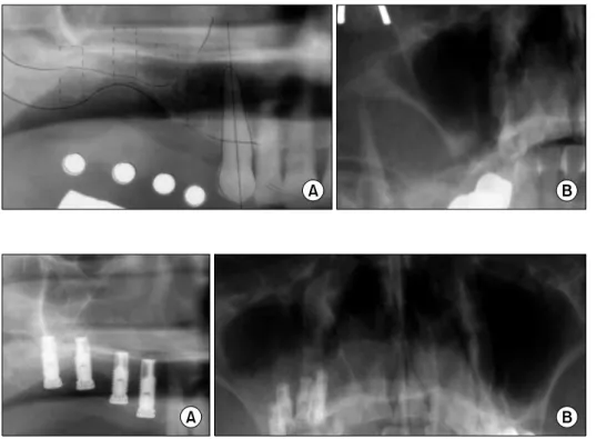Fig. 1. (A) Pre-operative panoramic  view of the right maxillary sinus with diagnostic stent