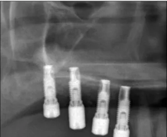 Fig. 3. Panoramic view of the right maxillary sinus after second