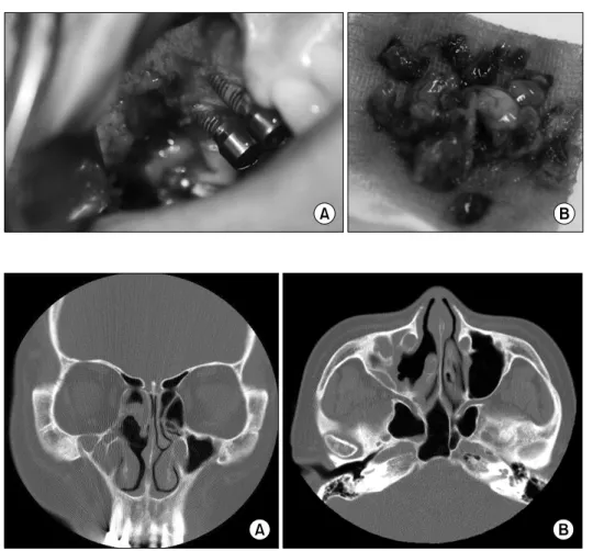 Fig. 6. (A) Caldwell-Luc operation  view showing bony resorption at  premolars. (B) Bone substitute and inflammatory tissue was removed  from the sinus.