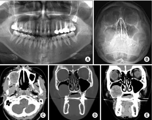 Fig. 1. (A) Dental panorama. (B)  Waters’view. (C) Axial computed  tomography (CT) image