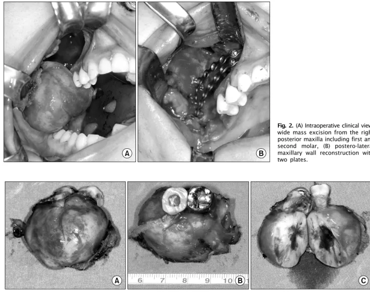 Fig. 2. (A) Intraoperative clinical view, wide mass excision from the right  posterior maxilla including first and second molar, (B) postero-lateral  maxillary wall reconstruction with  two plates.