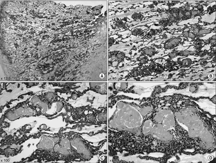 Fig. 4. Microscopic finding of dentinogenic ghost cell tumor showing odontogenic epithelium and numerous ghost cells with eosinophilic cytoplasm but without a nucleus, formed by sheets and islands of ameloblastic epithelium with peripheral columnar or cubo