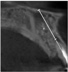 Fig. 1. Measure of the distance from the root tip to nasal floor  on cone beam computed tomography (by extension line of root canal) (a).서    론상악  전치부는  외상에  의한  치아결손  빈도가  높은  부위이다