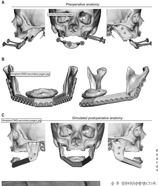Fig. 2. (A) Three-dimensional recon- recon-truction of high-reslolution  com-puted tomography scan of  craniofa-cial skeleton