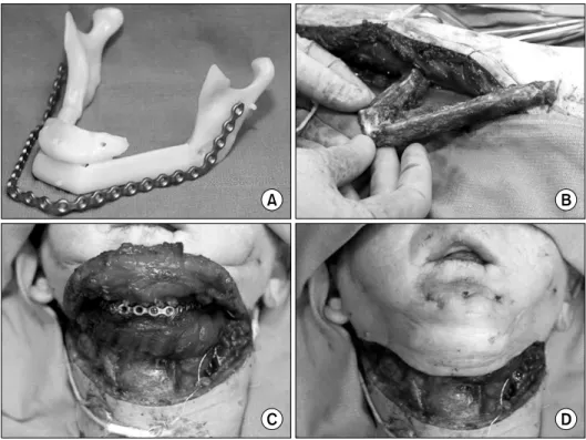 Fig. 4. (A) Stereolithographic model of neomandible and preadapted  plate. (B) Fibula free flap is harvested while the flap continues to be  perfused and shaped according to  the length of the template