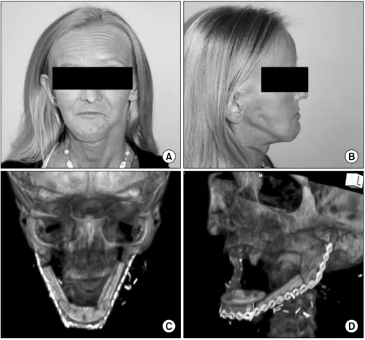 Fig. 5. Postoperative view. (A) Frontal, (B) lateral, (C) &amp; (D) 3-dimensional  tomographic images.