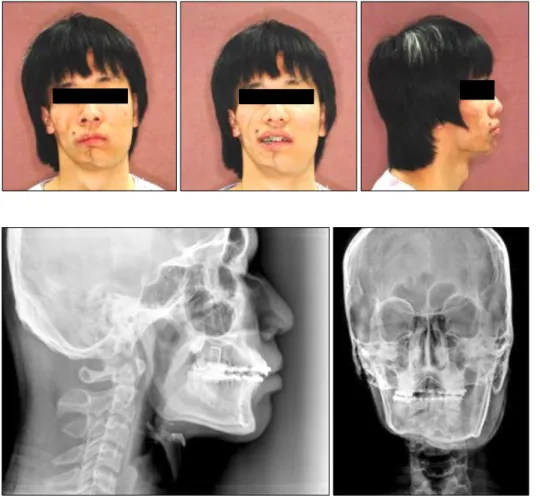 Fig. 1. Preoperative clinical photo- photo-graph. It shows right inferior border irregular appearance, rare hair, slight browny pigment and different skin texture.