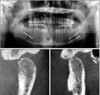Fig. 6. Postoprative panoramic view &amp; cone beam computed to- to-mography (postoperative 3 months).