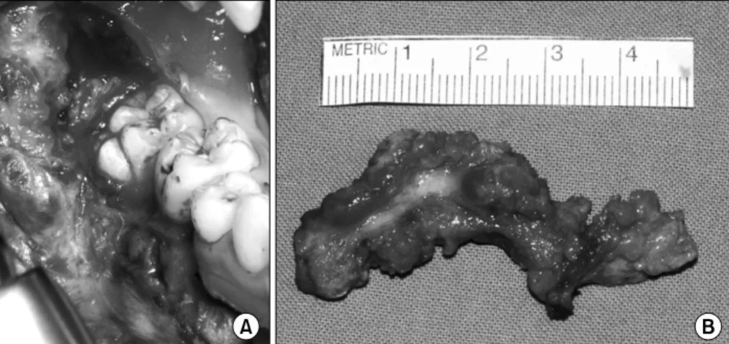 Fig. 3. (A) Intra-operative photograph.