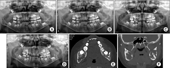 Fig. 7. (A) Post-operative 2 days panoramic view after incisional bone biopsy. (B) Post-operative 2 weeks panoramic view