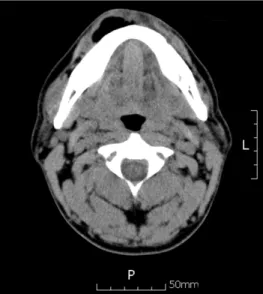 Fig. 5. Lipoma with fibrous capsule.