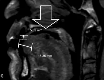 Fig. 1. Pre-operative view. Prominent lesion on tongue of ventral area have seen (arrow).