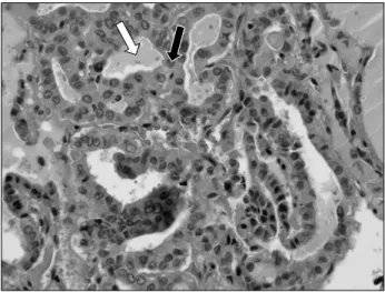 Fig. 5. Histopathologic view of extirpated lymph node at level  II, showing papillary thyroid