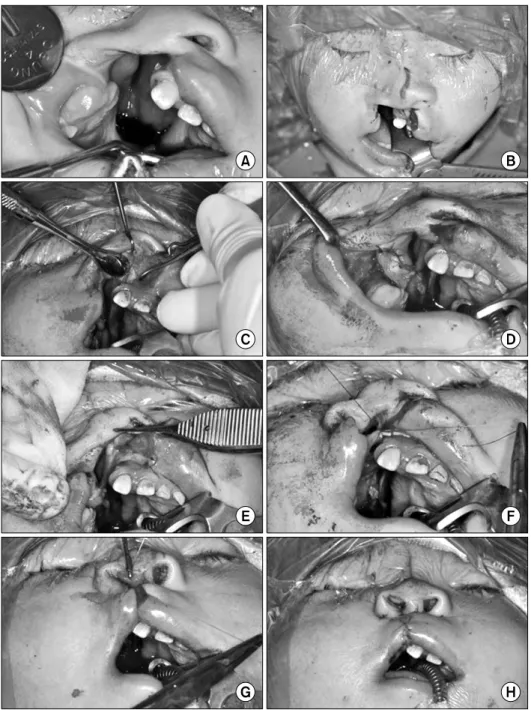 Fig. 2. Surgical procedures of patient 3, (A) unilateral cleft deformity, (B) surgical incisions, (C) seperation of the deformed nasal septum from  maxilla, (D) L flap, (E) M flap for  mucosal lining of rotation flap, (F)  formation of the vestibule, (G)  