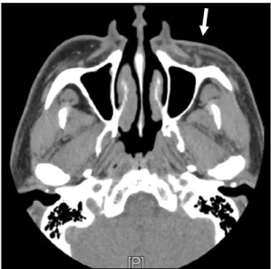 Fig. 2. Enhanced computed tomography view 15 months after  cyst enucleation. Subcutaneous lipodystrophy is seen left zygoma area (arrow).