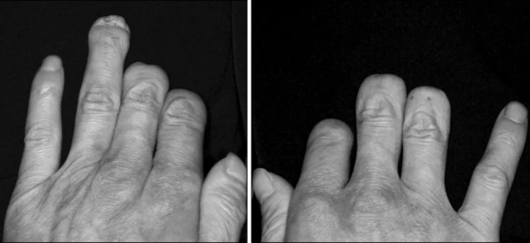 Fig. 2. The 2nd, 3rd, and 4th phalanges amputation of left foot. Fig. 3. Saddle nose appearance (arrow).