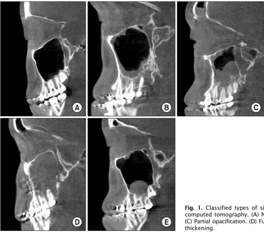 Fig. 2. Measurement of diameter of the maxillary sinus ostium (). 고    찰 이번  연구  결과  술  전  Cone  beam  CT상  상악동  점막의  이상  소견은  23%  (42/166)로  나타났다