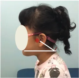 Fig.  1.  Measurement  of  craniovertebral  angle.