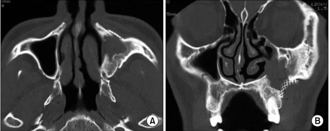 Table 1. Classification of maxillary sinus hypoplasia