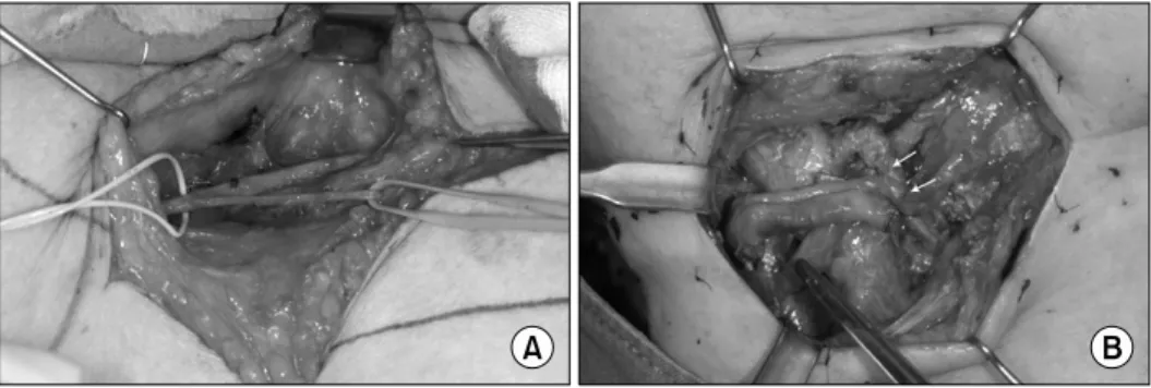 Fig. 6. Clinical dissected view show- show-ing great saphenous vein with left  surgical loop and external  pu-dendal vein with right surgical loop (A), and showing microanastomosed interpositional vein graft sites with  bright arrows between internal  jug-