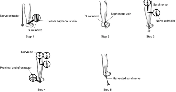 Fig. 2. Schematic diagrams showing sural nerve harvesting procedure by use of nerve extractor