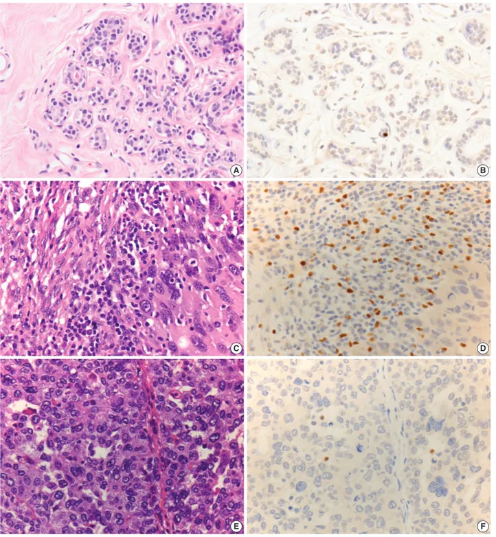 Fig. 1. Immunohistochemical stains (IHC) for Foxp3 in triple negative breast cancer (TNBC)