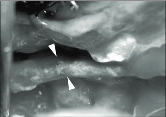 Fig. 1. Right inferior alveolar nerve exposure during sagittal split  ramus osteotomy.