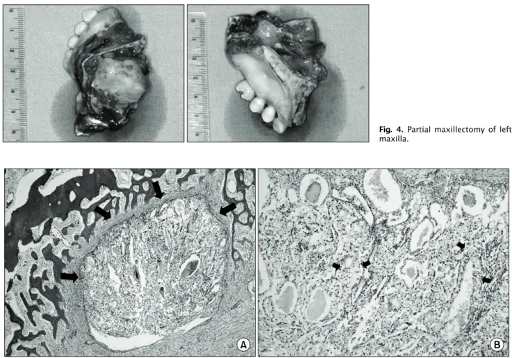 Fig. 4. Partial maxillectomy of left maxilla.