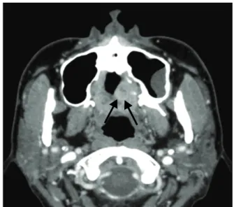 Fig. 7.  Soft  tissue  mass  with  the  diameter  of  2  cm  is  seen  in  the posterior region of the hard palate.
