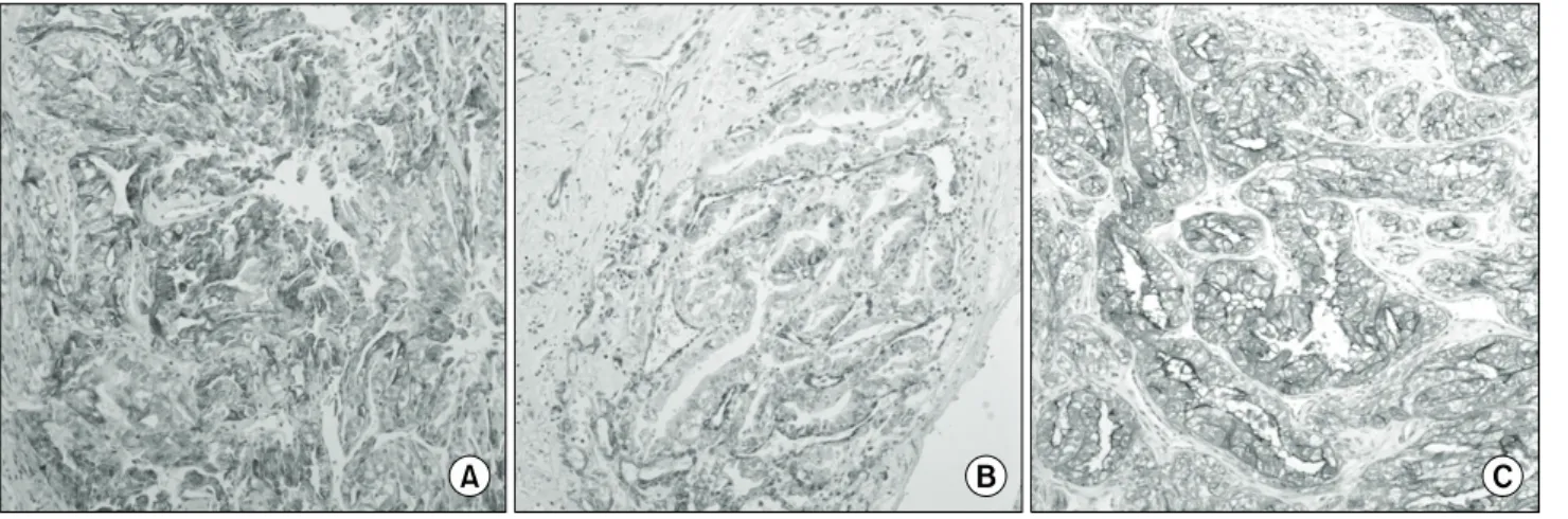 Fig. 3. The immunohistochemical stainings of the tumor cells result as follows: coexpression of pancytokeratin (A) &amp; Vimentin (B), and diffuse and strongly positive in CD10 (C) (H&amp;E, ×100).