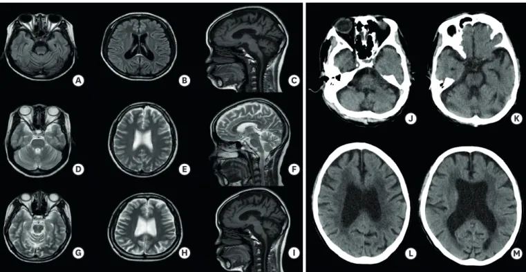 Fig. 2.  Brain MRI and brain CT in patients with DRPLA. Each image shows diffuse cerebral atrophic changes with prominent atrophy of the cerebellum and  brainstem in each patient IV-15 (A-C), IV-16 (D-F), and IV-17 (G-I)
