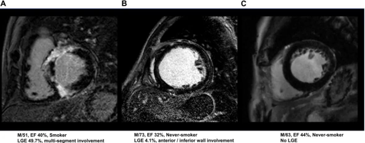 Figure 1.  Typical example of an LV-LGE in a smoker (multi-segment involves) and never-smoker.