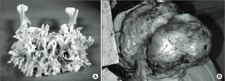 Fig. 3. (A) Rapid prototype model of the patient's mandible. (B) Intraoperative clinical photo that showed the extent of the lesion.