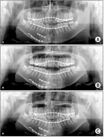 Fig. 5. (A) Closed treatment of left subcondyle, (B) postoperative 4 weeks panoramic view