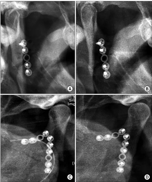 Fig. 6. (A, C) A slight malreduction under endoscopic view. (B, D)  Post-operative 4 months and 7 months, respectively
